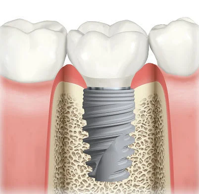 Couronne prothétique fixée sur un implant dentaire après ostéointégration