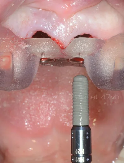 Pose d'un implant en chirurgie guidée